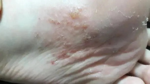 脚上起小水泡还很痒？别忽视，这几种常见原因在作怪
